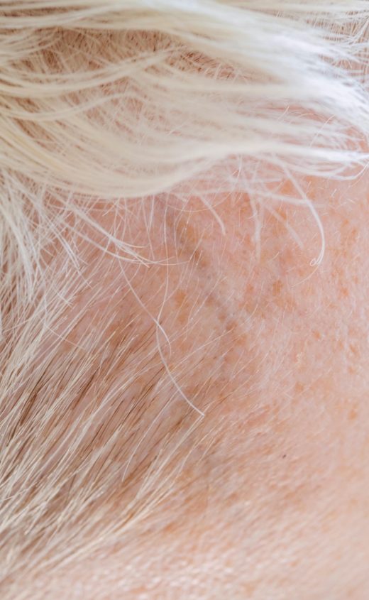 Le&#x20;PRP&#x20;&#x3A;&#x20;une&#x20;technique&#x20;de&#x20;r&#x00E9;g&#x00E9;n&#x00E9;ration&#x20;cellulaire&#x20;pour&#x20;le&#x20;cuir&#x20;chevelu&#x20;ou&#x20;la&#x20;peau