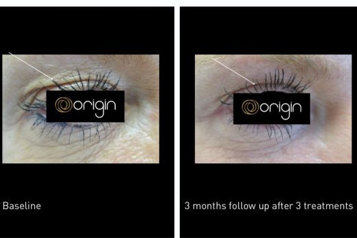 Blépharoplastie Médicale au Laser Origin : Un Regard Rajeuni Sans Chirurgie à l&#8217;Espace M&#038;V à la seyne sur mer près de six-fours et sanary