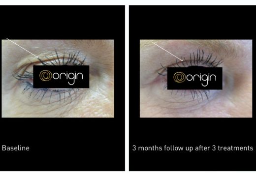Bl&#x00E9;pharoplastie&#x20;M&#x00E9;dicale&#x20;au&#x20;Laser&#x20;Origin&#x20;&#x3A;&#x20;Un&#x20;Regard&#x20;Rajeuni&#x20;Sans&#x20;Chirurgie&#x20;&#x00E0;&#x20;l&amp;&#x23;8217&#x3B;Espace&#x20;M&amp;&#x23;038&#x3B;V&#x20;&#x00E0;&#x20;la&#x20;seyne&#x20;sur&#x20;mer&#x20;pr&#x00E8;s&#x20;de&#x20;six-fours&#x20;et&#x20;sanary
