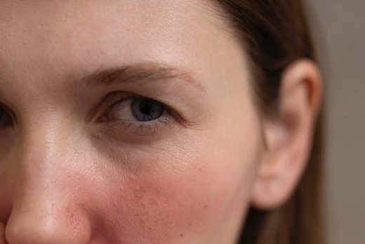 Laser vasculaire: une solution efficace pour la couperose, rougeurs, varices à la seyne sur mer
