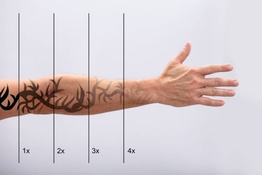 Votre tatouage est devenu un regret ? Ne tardez plus ! Détatouage laser dans le var à toulon