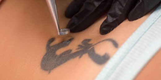 Centre laser pour détatouage dans le Var à côté de Toulon (83)