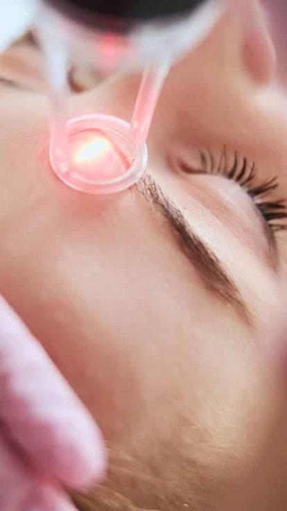 Laser vasculaire pour couperose, télangiectasies, rougeurs et varices superficielles près de Toulon