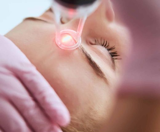 Laser vasculaire pour couperose, télangiectasies, rougeurs et varices superficielles près de Toulon