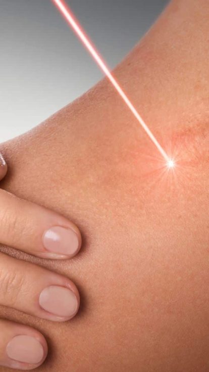 Traitement laser pour cicatrices, acné, rides et vergetures près de Toulon
