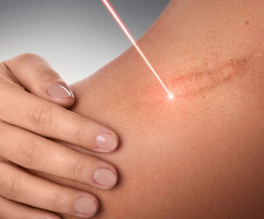 Traitement laser pour cicatrices, acné, rides et vergetures près de Toulon