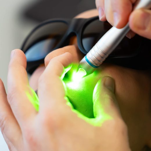 Laser vasculaire pour couperose, télangiectasies, rougeurs et varices superficielles près de Toulon